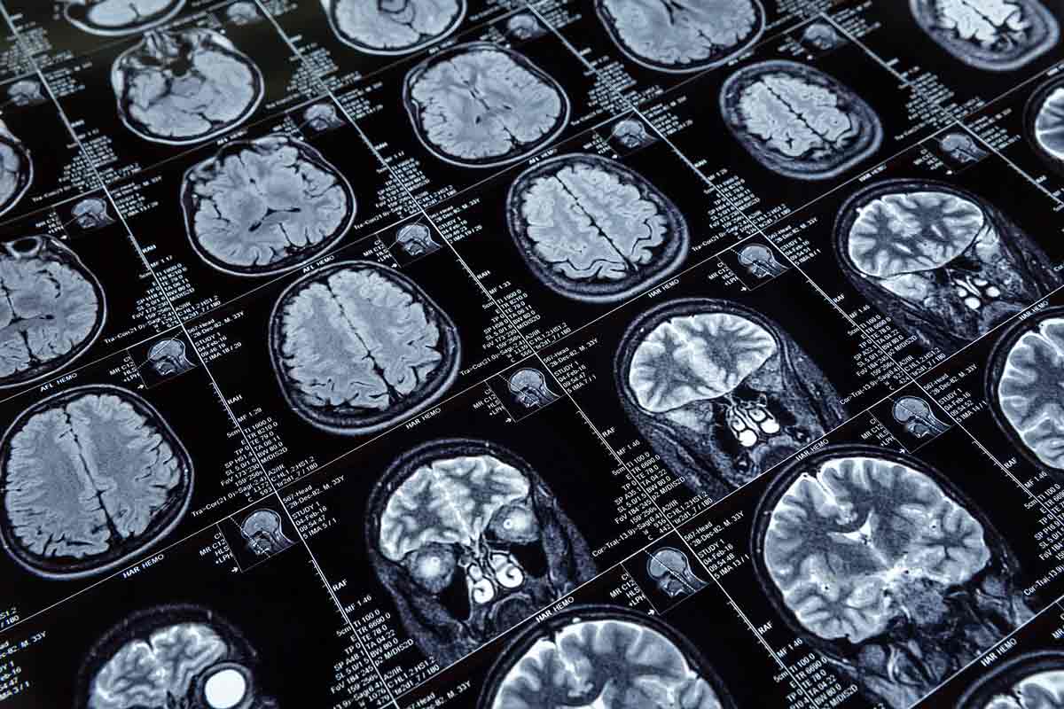 Alzheimer – topografía del cerebro